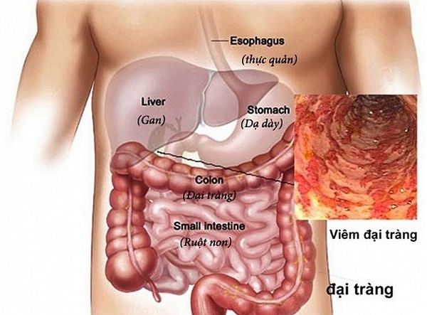 Do mắc bệnh viêm đại tràng