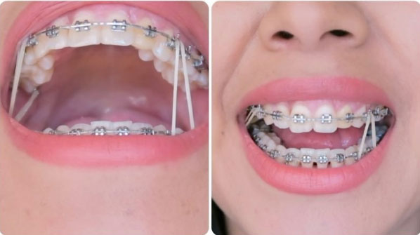 Nha khoa niềng răng ở quận 7 giá tốt