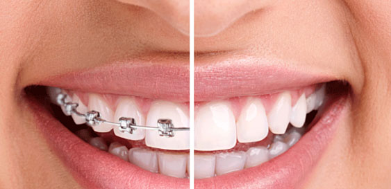 Niềng răng tại nha khoa uy tín tại quận 7 được hỗ trợ trả góp