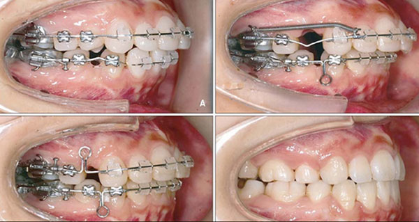 Dịch vụ niềng răng hô tại quận 9 chất lượng