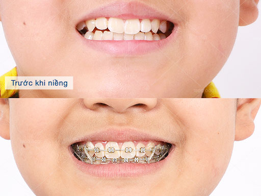 Niềng răng tại nha khoa được cấp giấy phép hành nghề của Bộ Y tế
