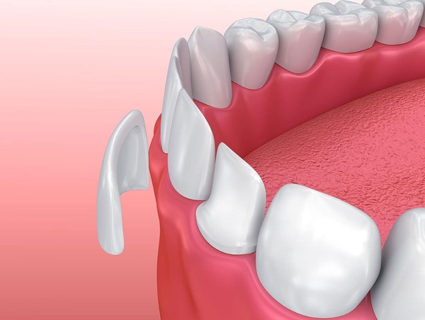 Keo dán răng sẽ cố định răng sứ trên cùi răng thật