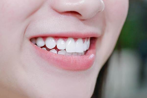 Keo dán đảm bảo cho răng không bị rơi ra ngoài, cố định hoàn toàn trên răng