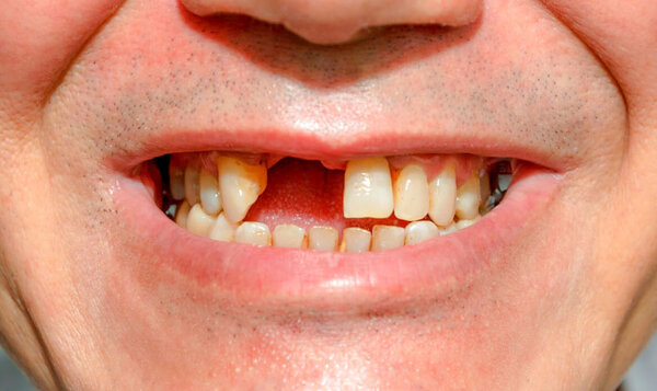 Mơ thấy rụng răng cửa.