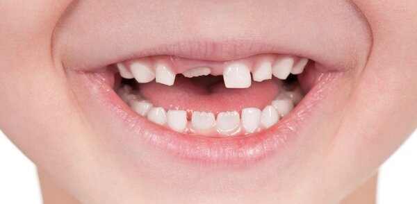 Răng sữa và răng vĩnh viễn có mối quan hệ mật thiết với nhau trong quá trình phát triển răng miệng.
