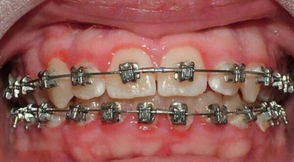 Niềng răng bị sưng nướu gây ảnh hưởng nhiều đến sức khoẻ.